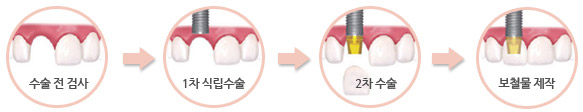 수술 전 검사 > 1차 식립수술 > 2차 수술 > 보철물 제작